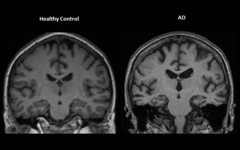 Surgery and Neuroinflammation